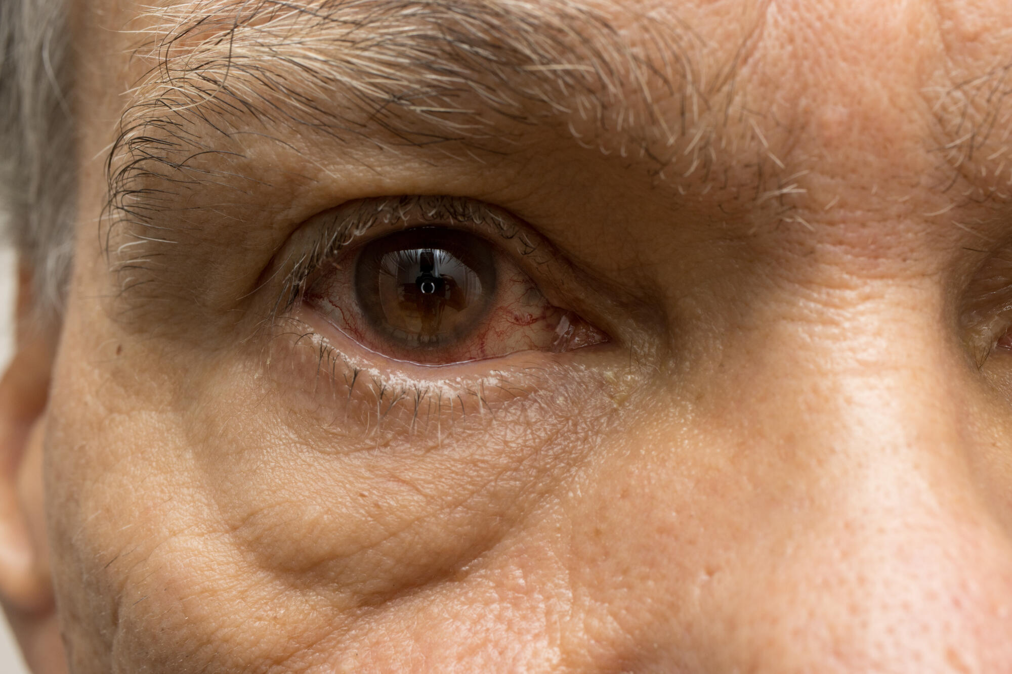 Hypertensive Retinopathy vs Diabetic Retinopathy: What's the Difference?